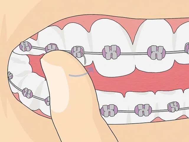 سیم ارتودنسی را به عقب خم کنید