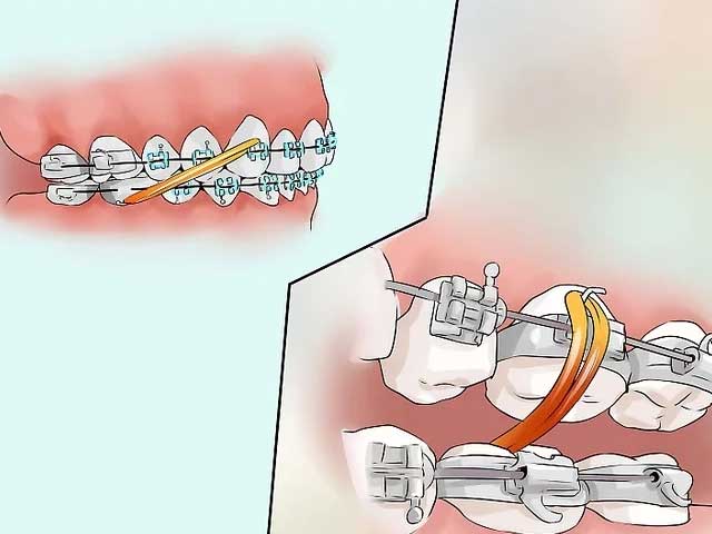 برداشتن نوار کشی دهان