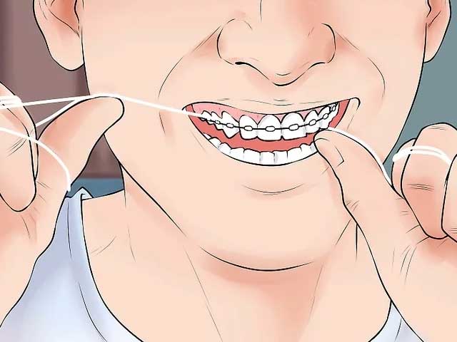 کشیدن نخ دندان ارتودنسی