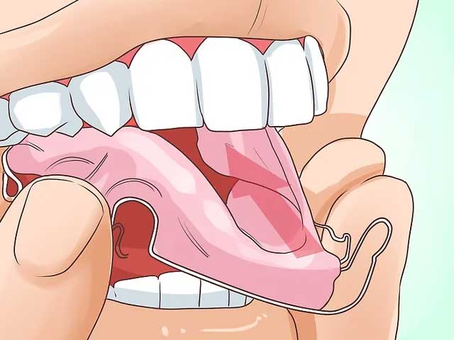 نگهدارنده ارتودنسی را با دقت در دهان خود قرار دهید. 