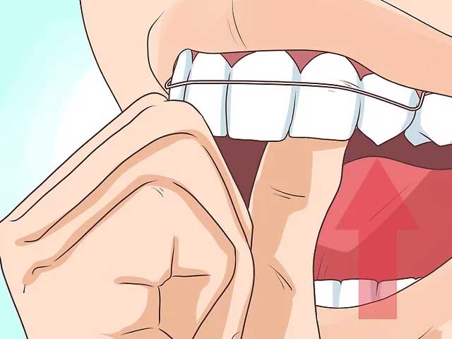 نگهدارنده ارتودنسی را به دندان های عقبی خود محکم قلاب کنید. 