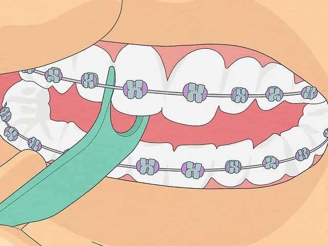 نخ دندان کشیدن و شستن دندان ارتودنسی شده