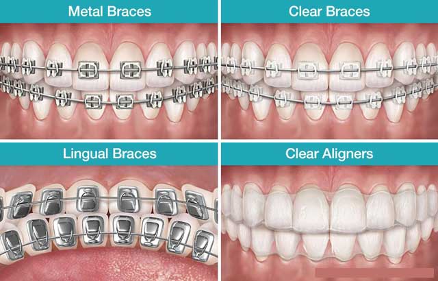 انواع  بریس های ارتودنسی برای کودکان
