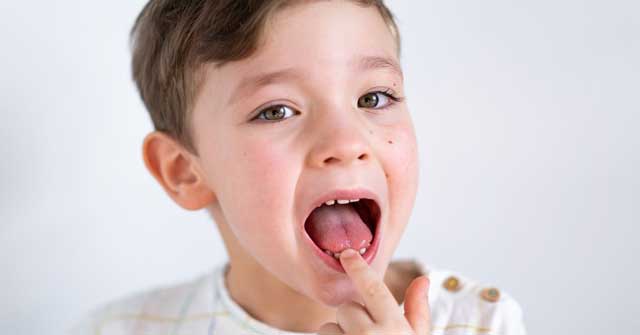 دندان های کج در کودکان