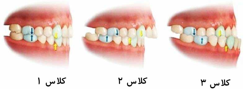 مال اکلوژن کلاس 1 و 2 و 3