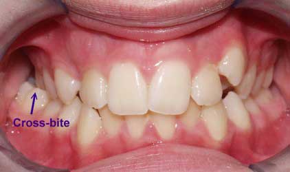 مال اکلوژن کراس بایت خلفی
