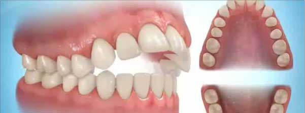 مال اکلوژن اپن بایت