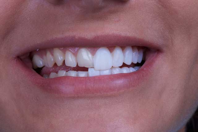 درمان دندان کج بدون ارتودنسی
