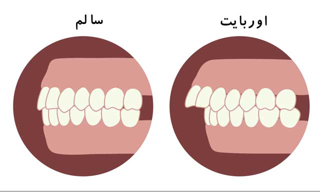 مقایسه اکلوژن طبیعی در دندان سالم (چپ) و مال اکلوژن اوربایت (راست)