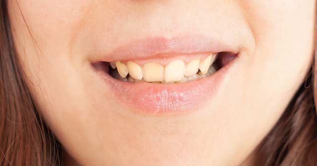 درمان اوربایت و فاصله بین دندانی با ارتودنسی متحرک
