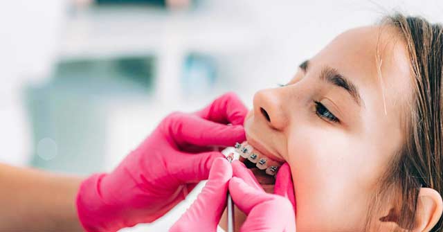درمان شلوغی دندان در کودکان
