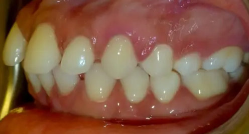 علل فاصله بین دندان