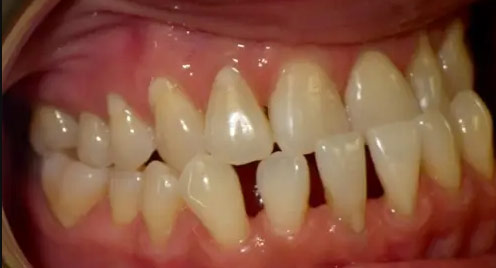 تحلیل لثه و فاصله بین دندان