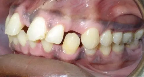اوربایت و فاصله بین دندان