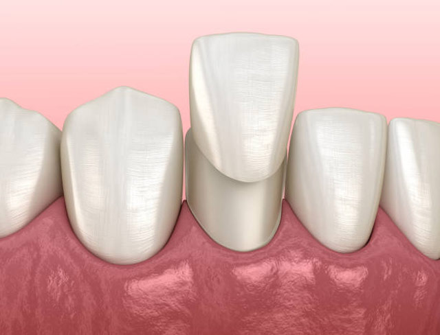 درمان اورجت با روکش دندان
