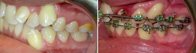 کشیدن دندان برای درمان ارتودنسی