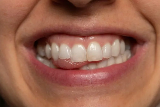 نقش دندان ها در صحبت کردن و نیاز به اردتودنسی در گفتار