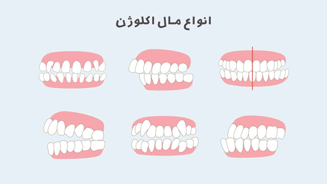 انواع مال اکلوژن یا بایت بد