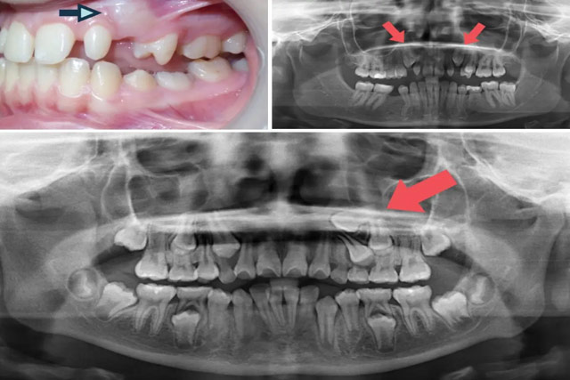 دندان نهفته چیست؟علائم، تشخیص و درمان