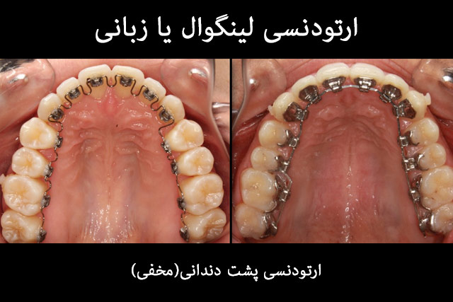 ارتودنسی لینگوال که به ارتودنسی زبانی یا پشت دندانی
