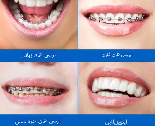 بررسی ارتودنسی های زبانی در برابر ارتودنسی های فلزی رایج