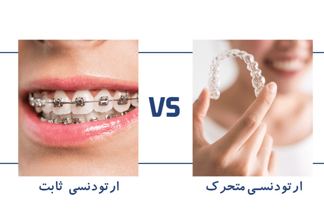 ارتودنسی متحرک بهتر است یا ثابت