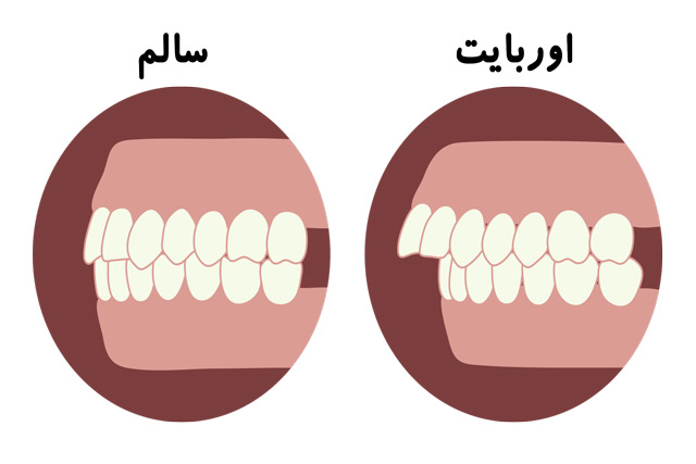 درمان عقب بودن فک پایین(اوربایت) بدون جراحی