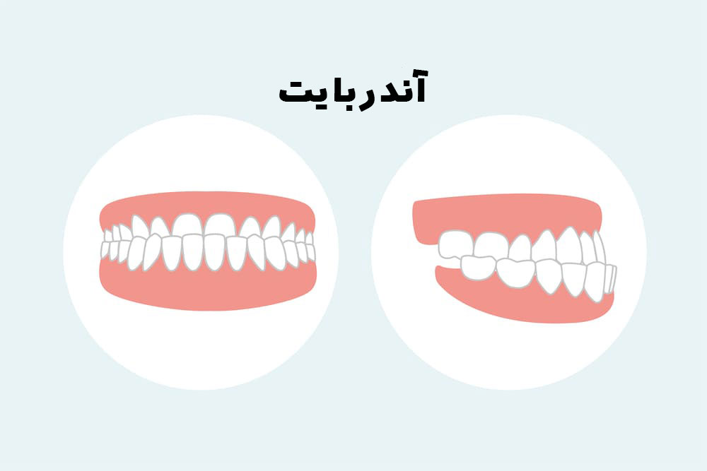 درمان جلو بودن دندان و فک پایین (آندربایت)