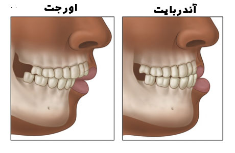 آندربایت