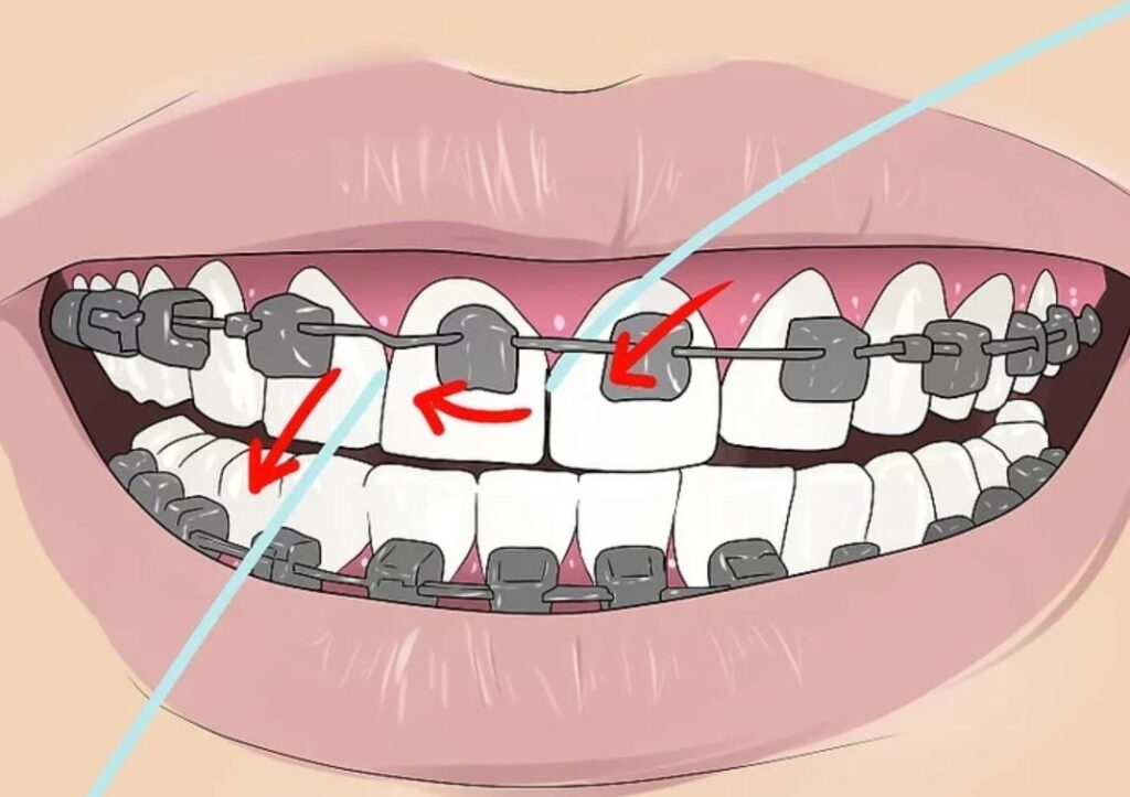 نخ دندان را بین دندان ها قرار دهید