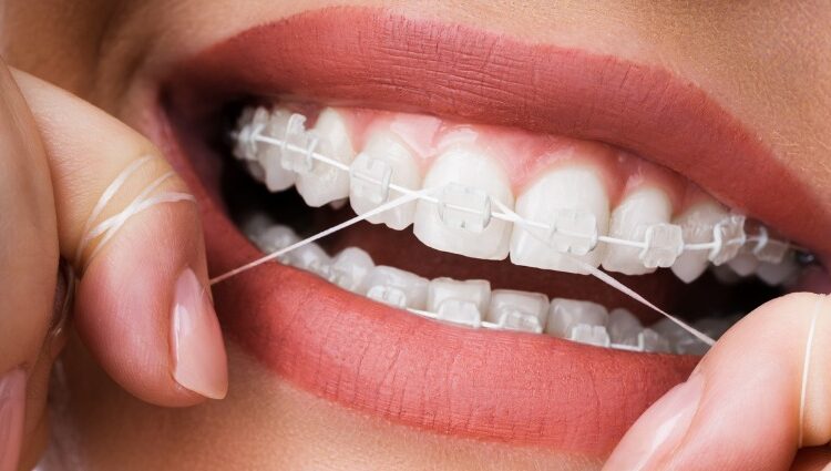 نحوه نخ دندان کشیدن ارتودنسی