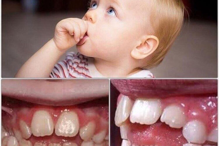مکیدن شست و دندان های کودک شما