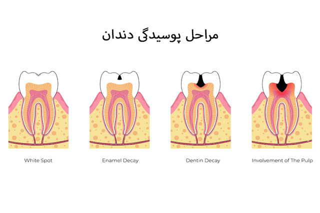 5 مرحله پوسیدگی دندان