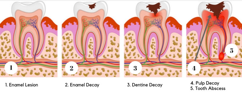 تشخیص مراحل پوسیدگی دندان