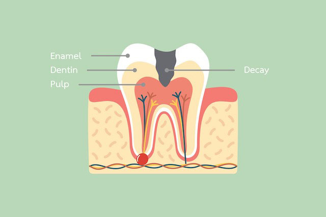 پوسیدگی دندان چیست؟