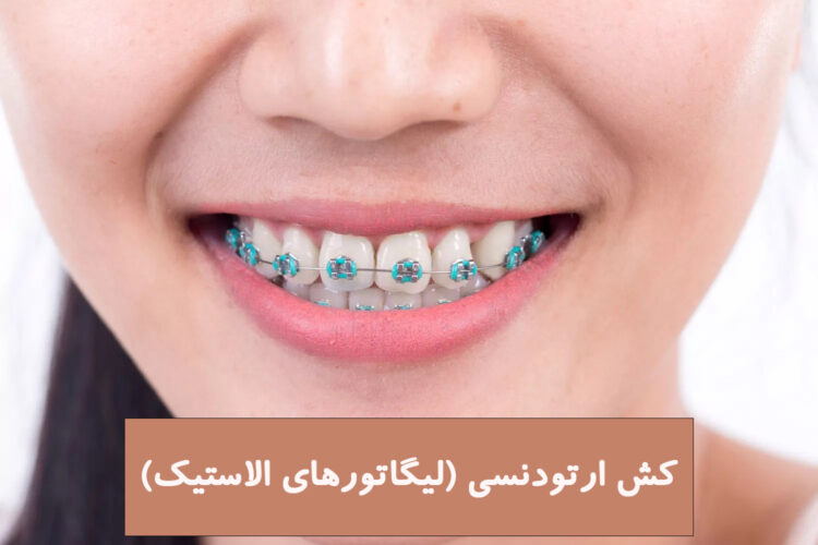 کش ارتودنسی (لیگاتورهای الاستیک)