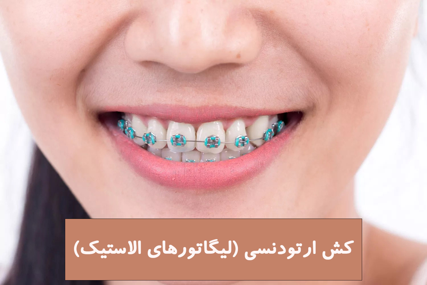 کش ارتودنسی (لیگاتورهای الاستیک)