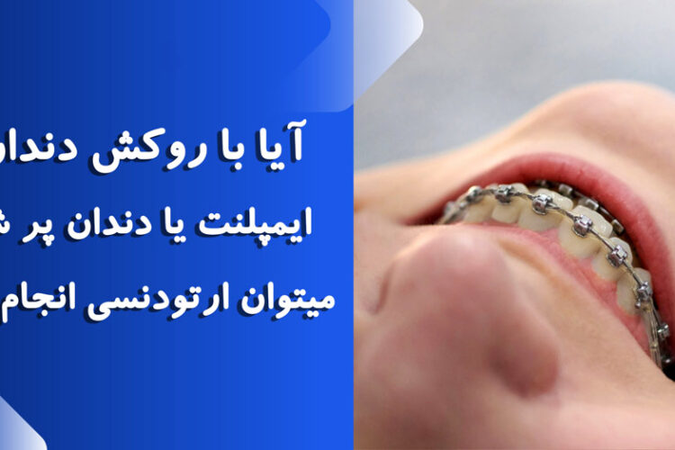 آیا با روکش دندان یا ایمپلنت میتوان ارتودنسی انجام داد؟