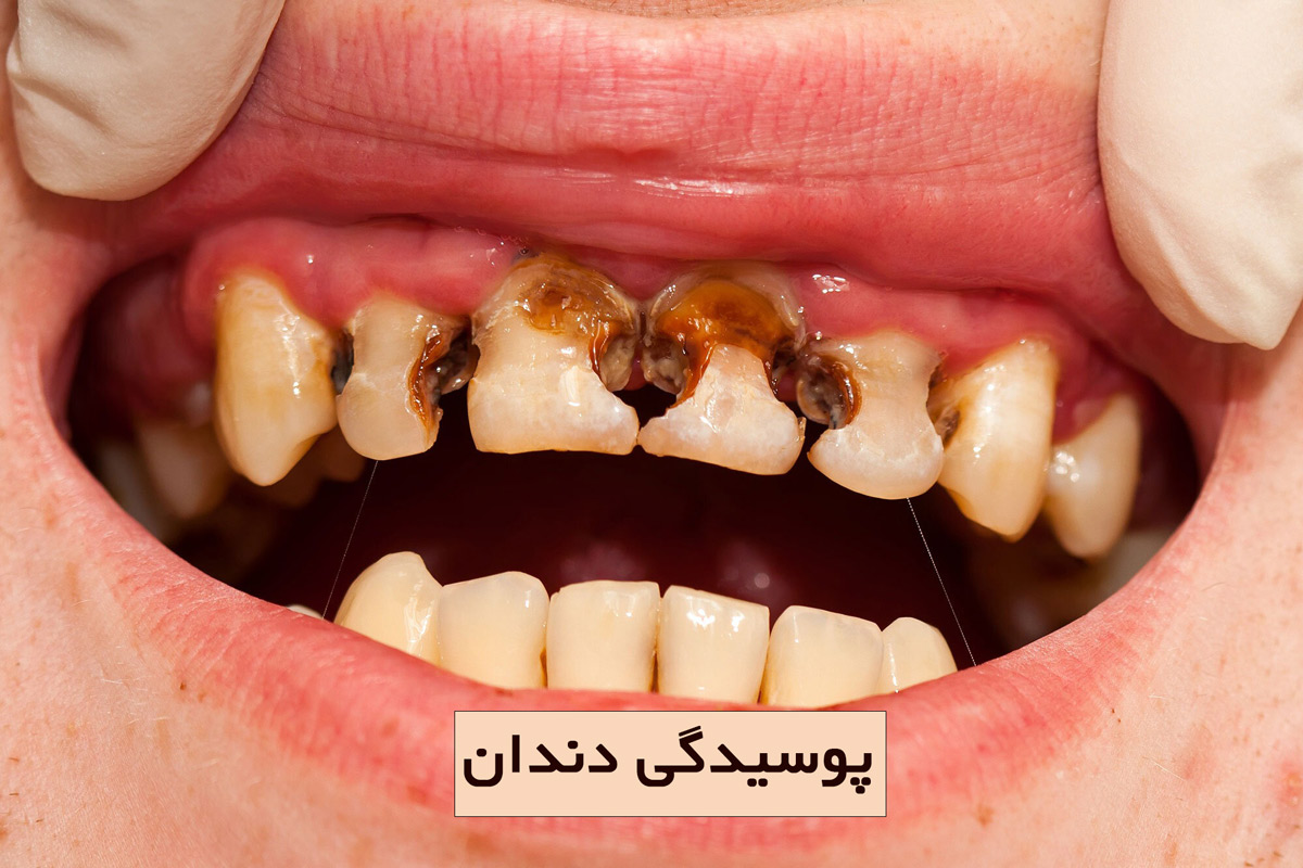 پوسیدگی دندان چیست؟