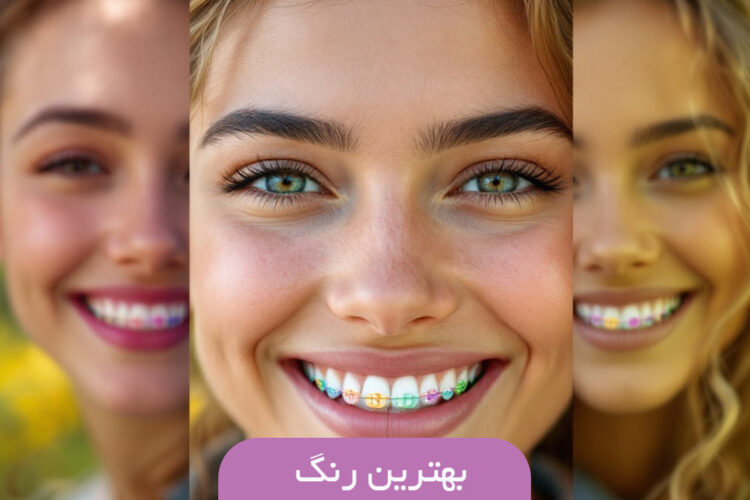 بهترین رنگ های ارتودنسی دخترانه