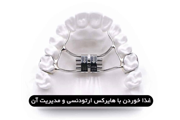 چگونه با هایرکس (وسیع کننده کام) غذا بخوریم و مدیریتش کنیم؟