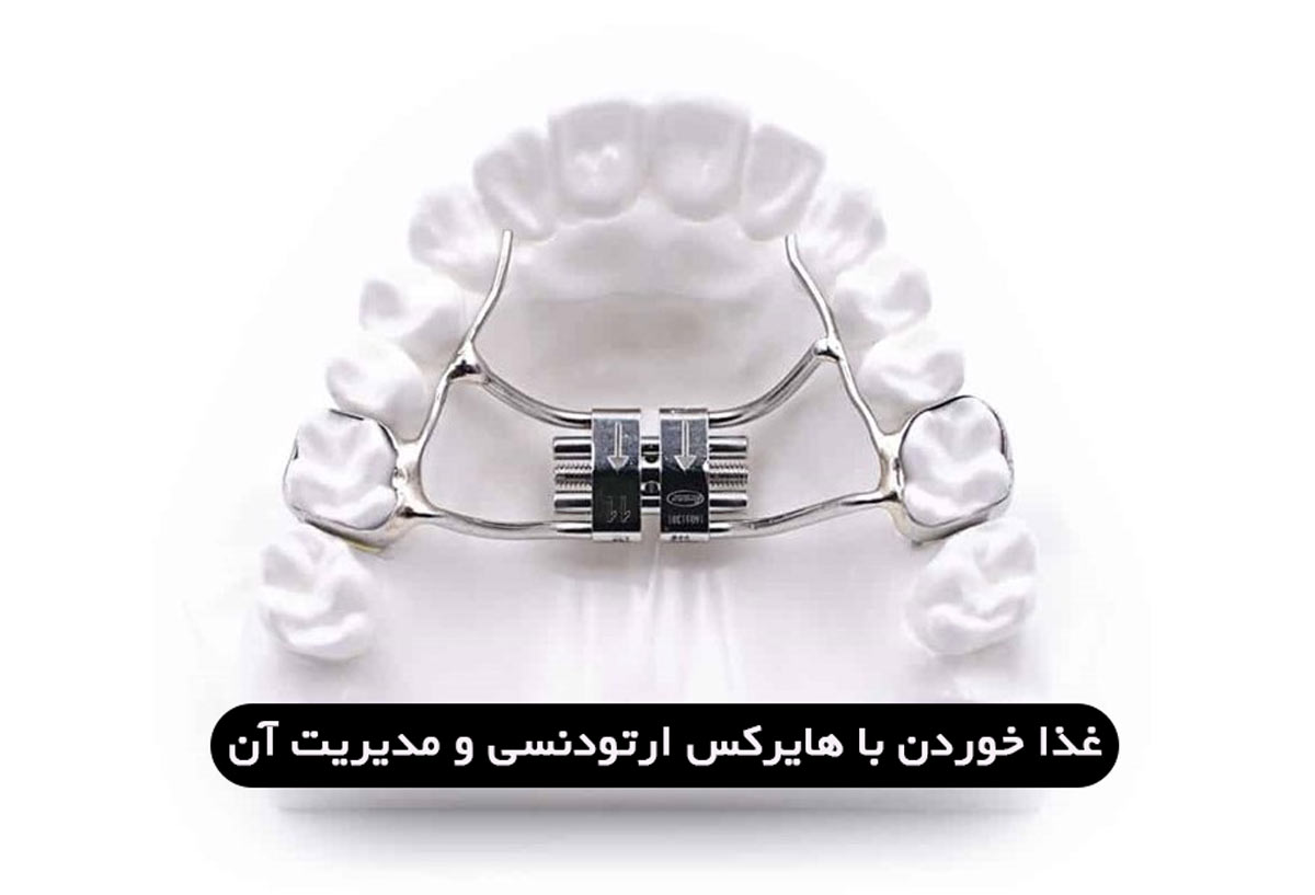 چگونه با هایرکس (وسیع کننده کام) غذا بخوریم و مدیریتش کنیم؟