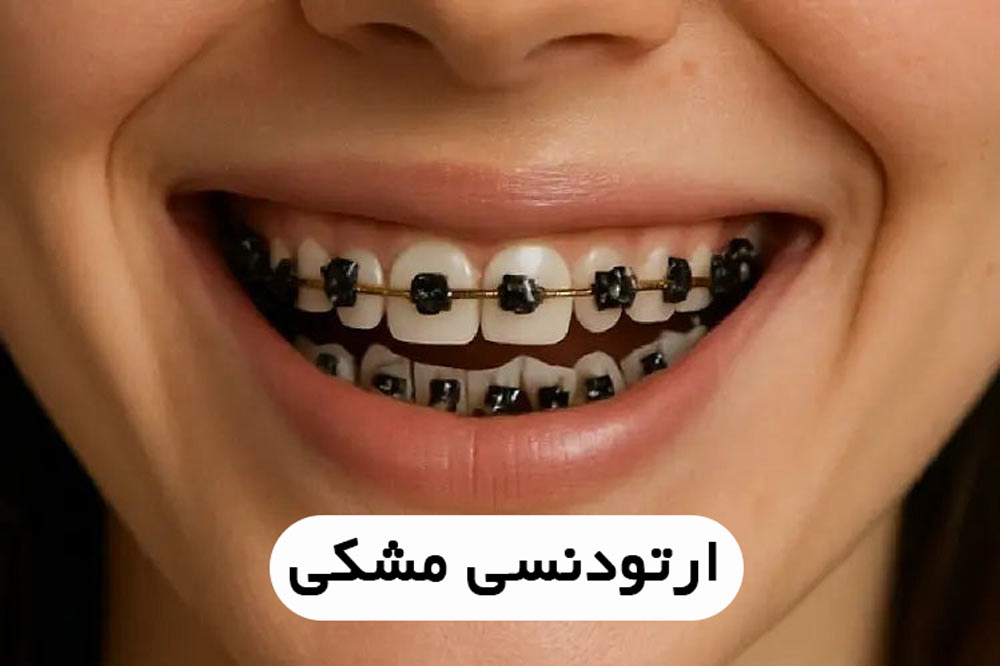 ارتودنسی مشکی