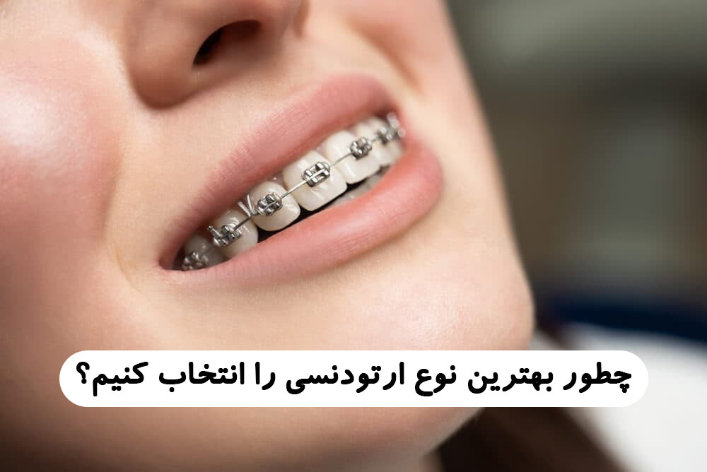 چطور بهترین نوع ارتودنسی را انتخاب کنیم؟