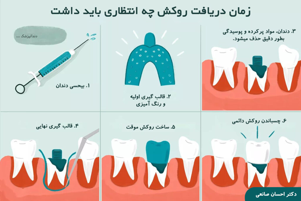 روکش دندان