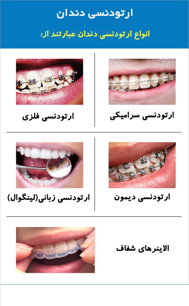 بهترین نوع ارتودنسی | انواع ارتودنسی