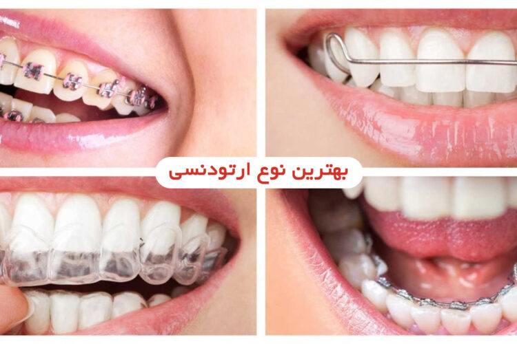 بهترین نوع ارتودنسی