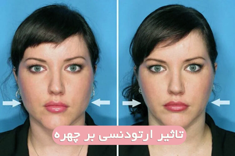 آیا ارتودنسی صورت شما را تغییر می دهد؟