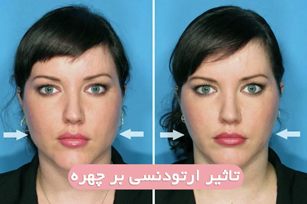 آیا ارتودنسی صورت شما را تغییر می دهد؟