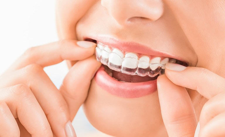 الاینرهای شفاف (اینویزیلاین)